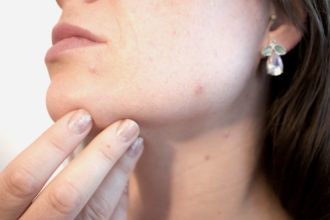 Cómo combatir el acné