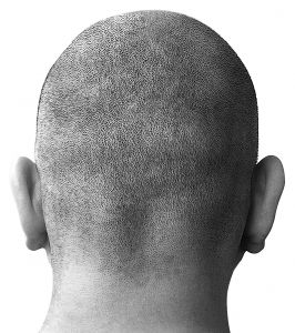 combatir la alopecia